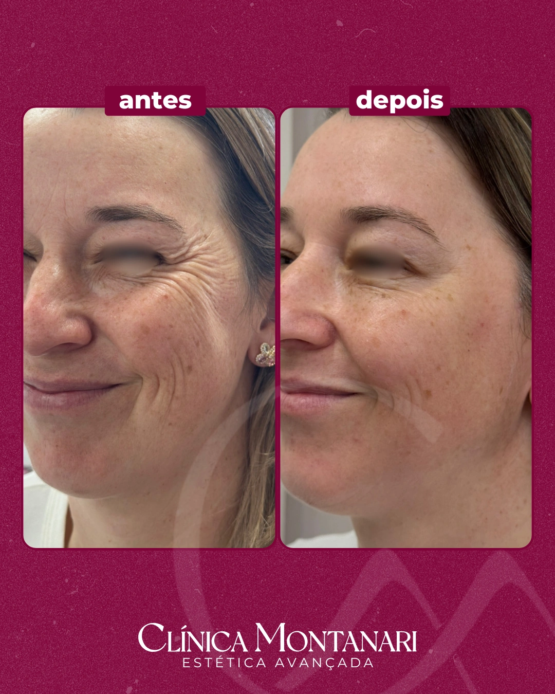 Resultado Clínica Montanari