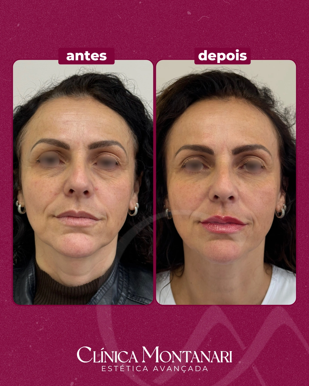 Resultado Clínica Montanari