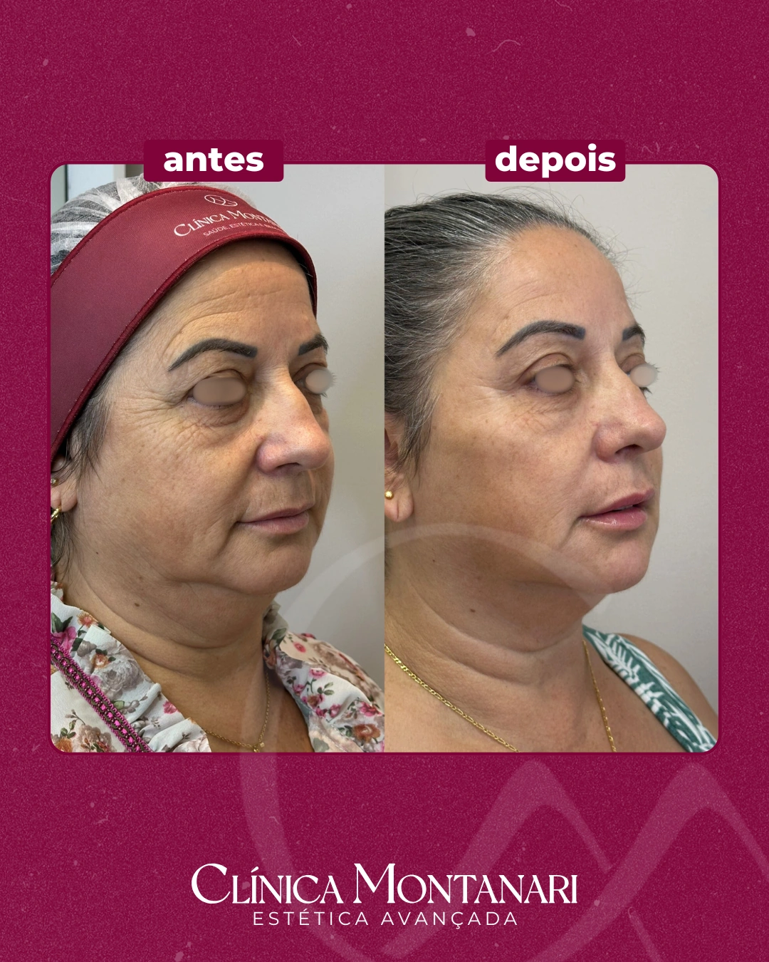 Resultado Clínica Montanari