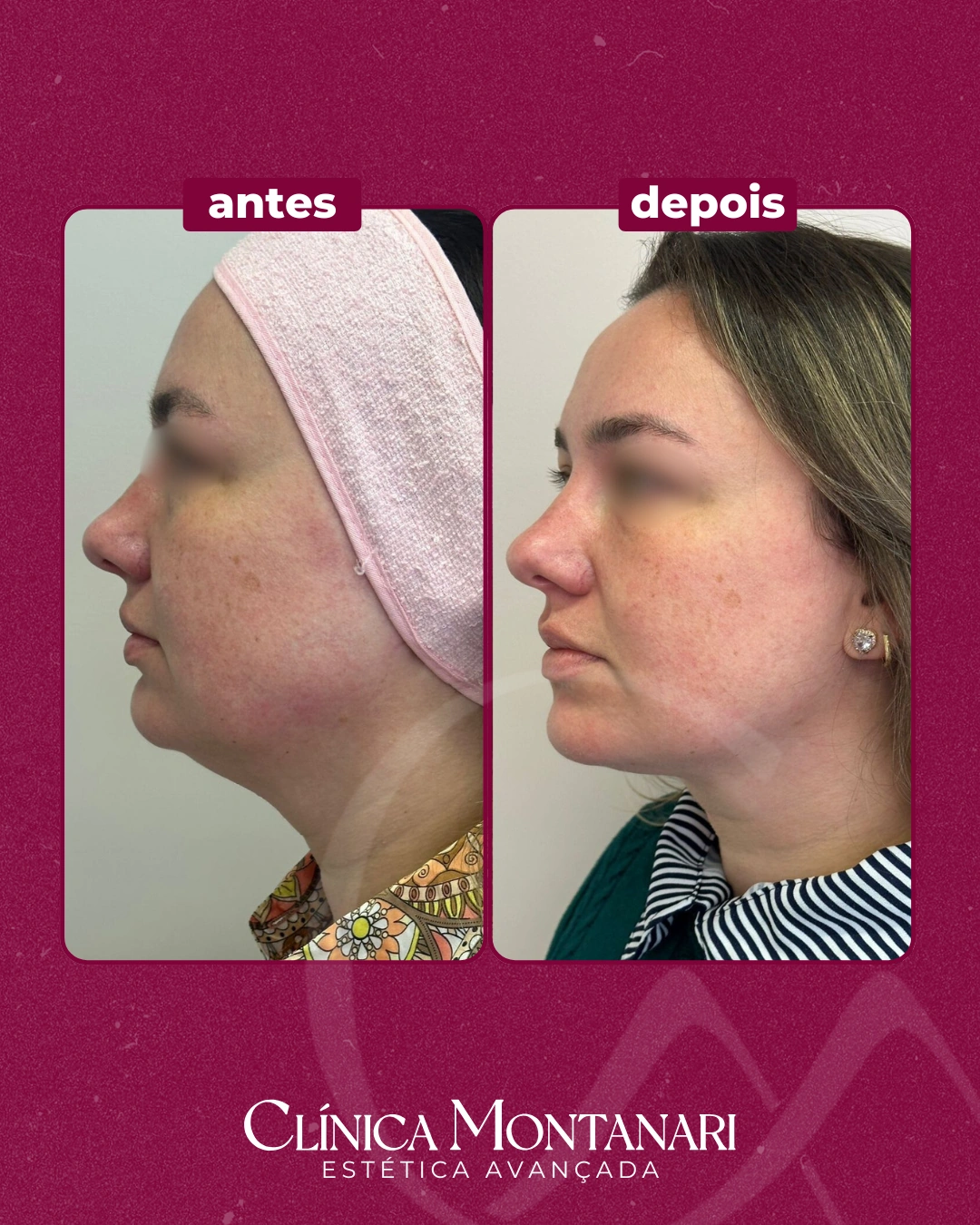 Resultado Clínica Montanari