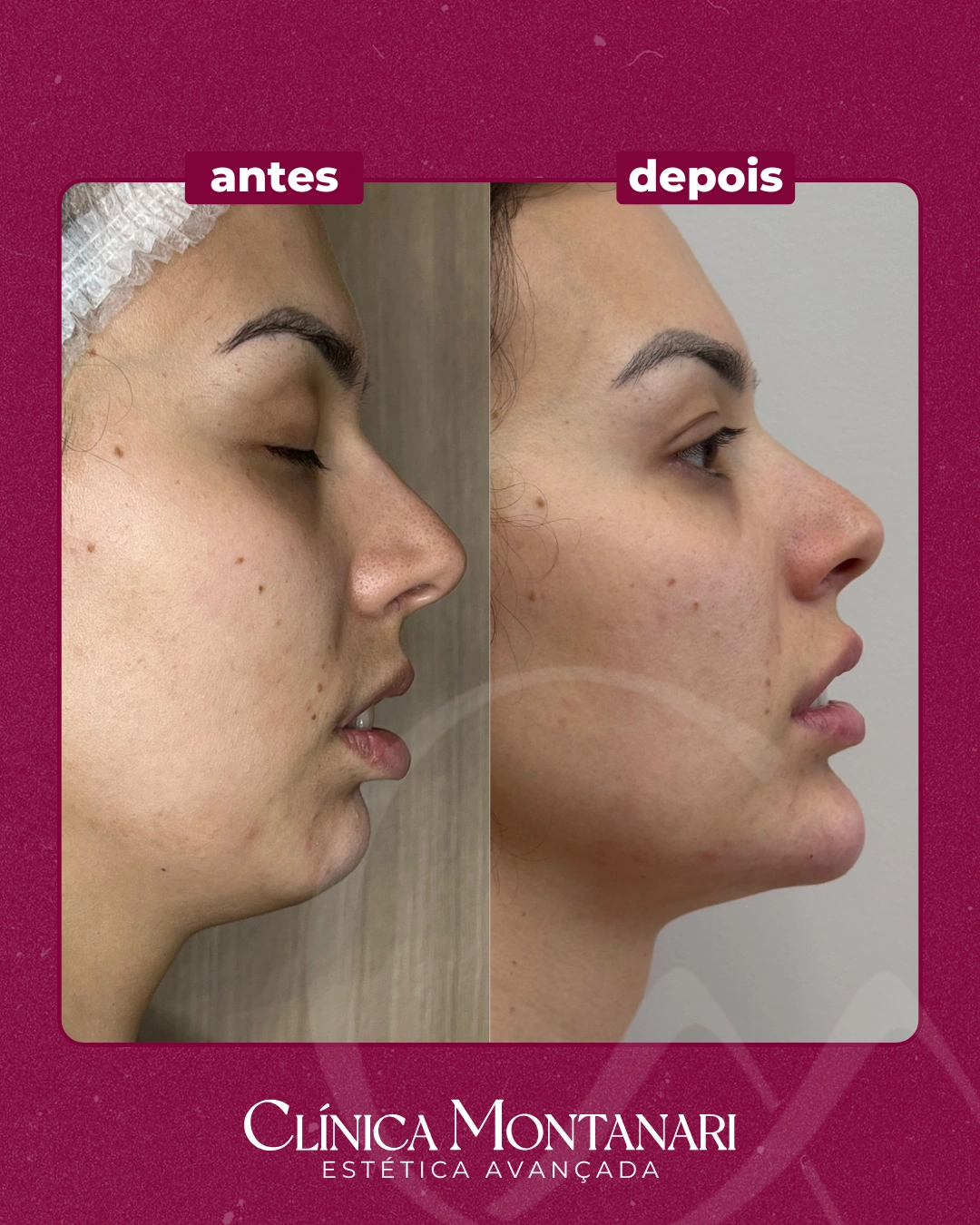 Resultado Clínica Montanari