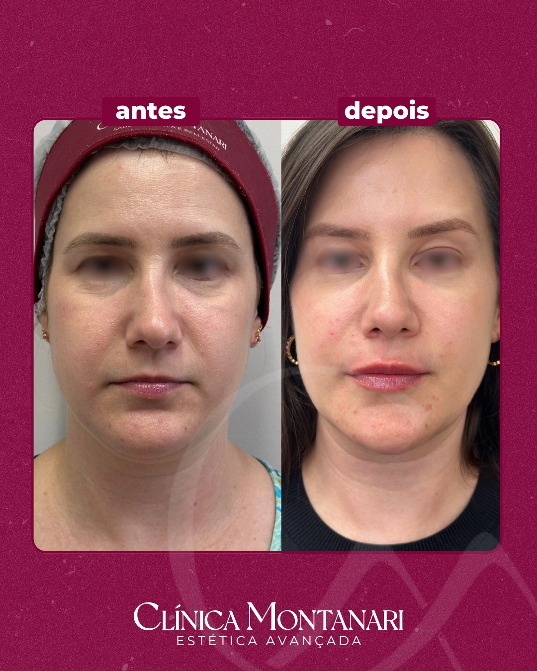 Resultado Clínica Montanari