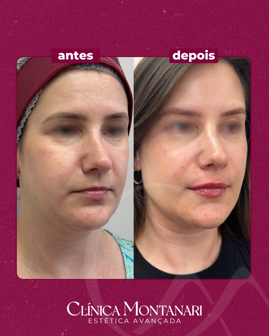 Resultado Clínica Montanari