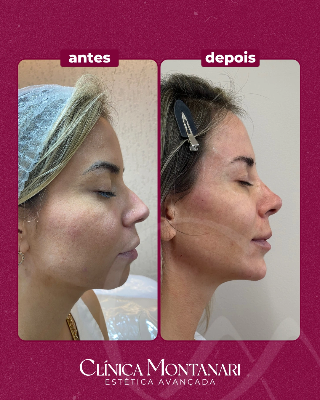 Resultado Clínica Montanari