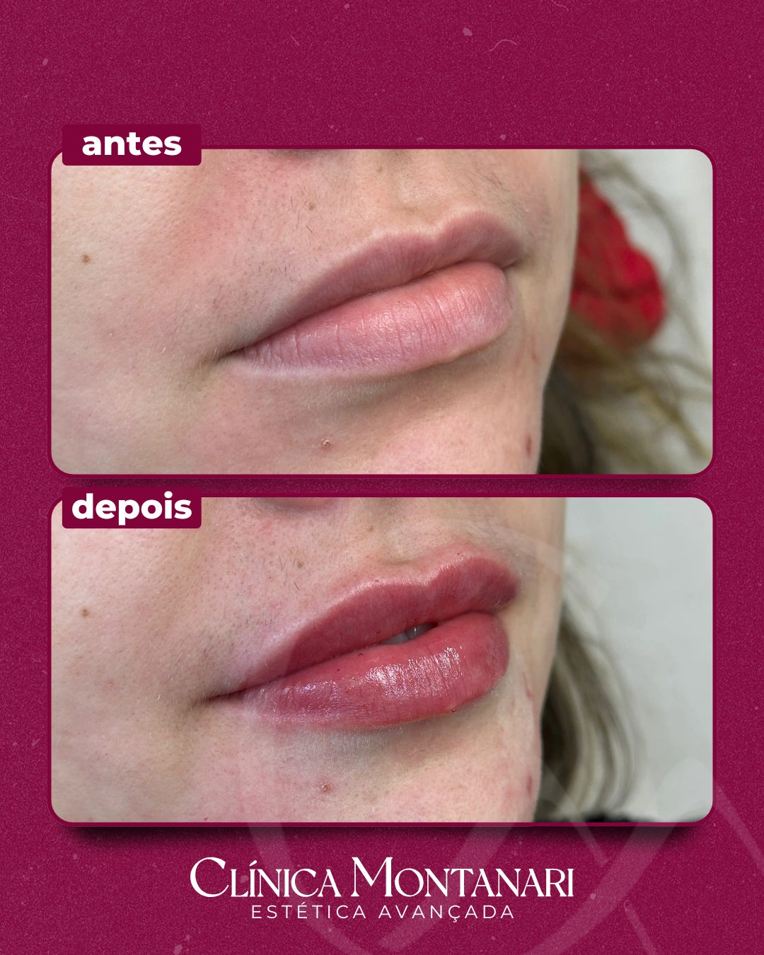 Resultado Clínica Montanari